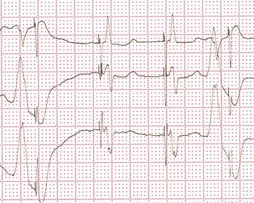 XV_4index